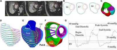 Multi-Band Surgery for Repaired Tetralogy of Fallot Patients With Reduced Right Ventricle Ejection Fraction: A Pilot Study